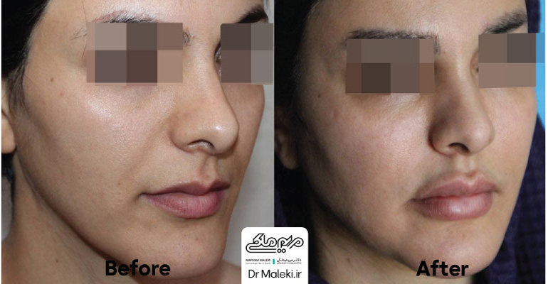 عکسهای تزریق چربی دکتر مریم ملکی اصفهان