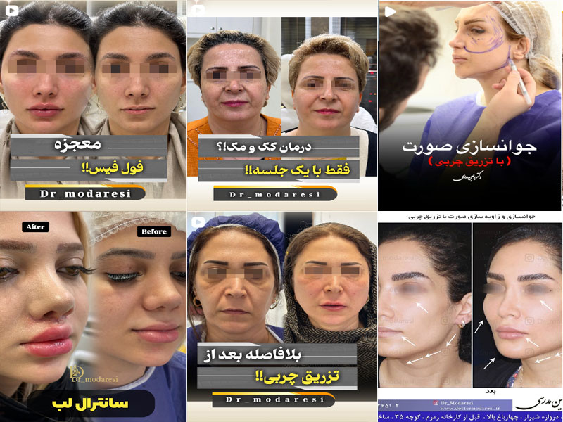 عکس نمونه کار زیبایی دکتر رامین مدرسی