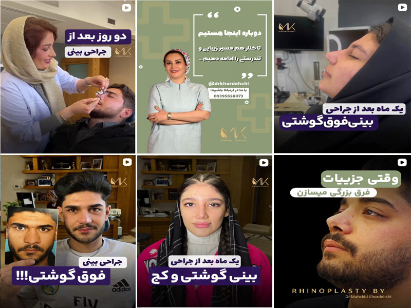 نمونه کار جراحی بینی دکتر مهشید خورده چی اصفهان