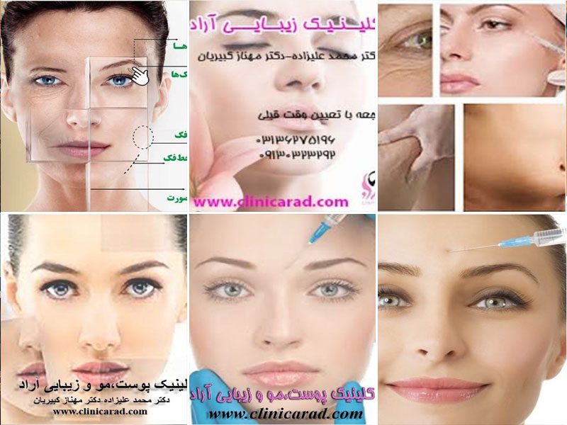 نمونه کار تزریق ژل کلینیک آراد اصفهان