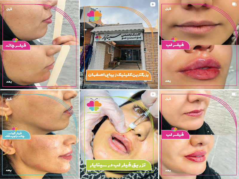 نمونه کار تزریق فیلر در کلینیک سینایار اصفهان