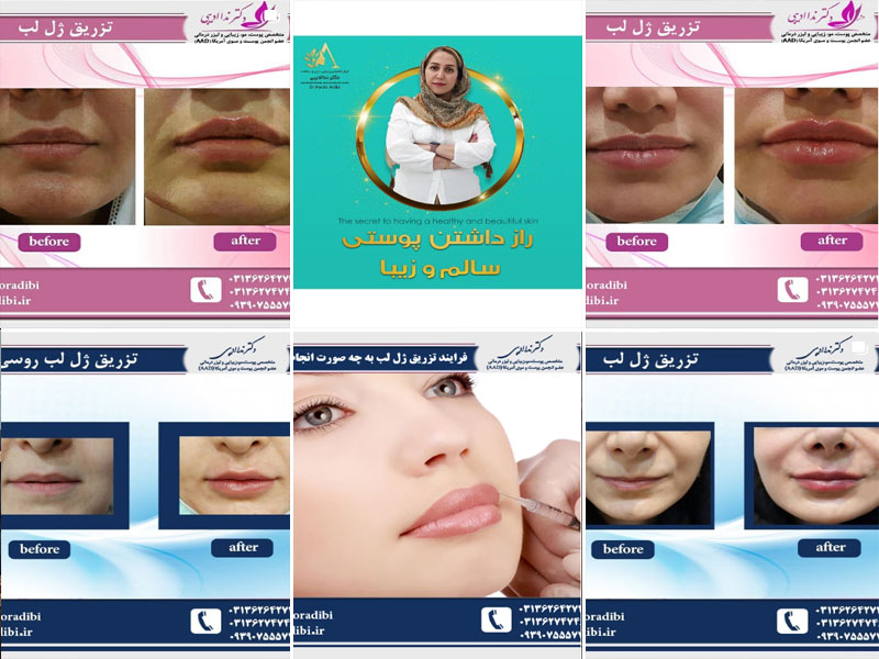 نمونه کار تزریق ژل لب توسط دکتر ندا ادیبی اصفهان