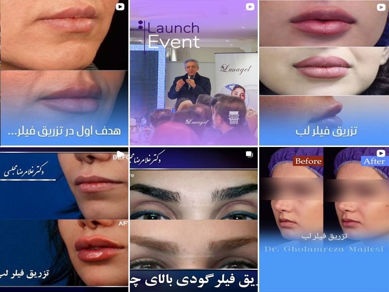 نمونه کار دکتر غلامرضا مجلسی تزریق فیلر اصفهان