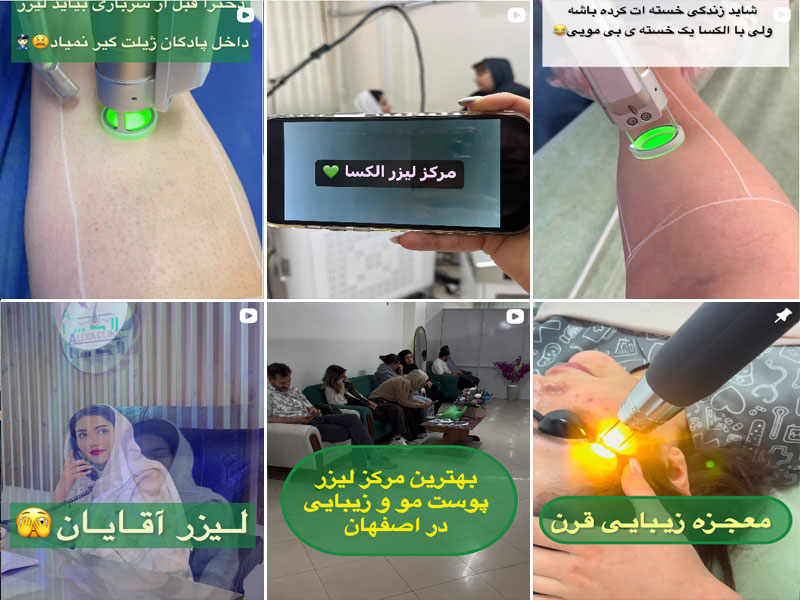 لیزر الکسا اصفهان