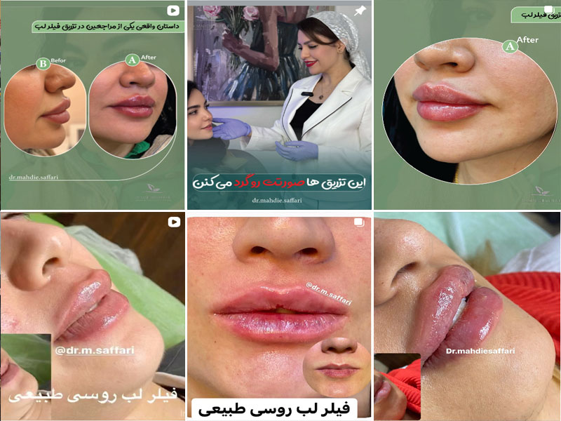 نمونه کار تزریق ژل لب روسی طبیعی توسط دکتر مهدیه صفاری اصفهان