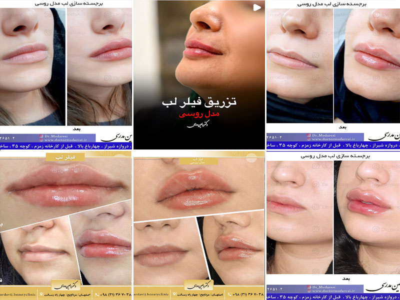 نمونه کار تزریق فیلر لب روسی دکتر رامین مدرسی اصفهان