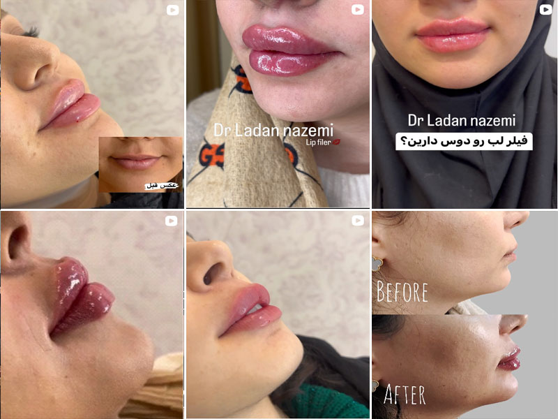 نمونه کار تزریق ژل لب روسی دکتر لادن ناظمی اصفهان