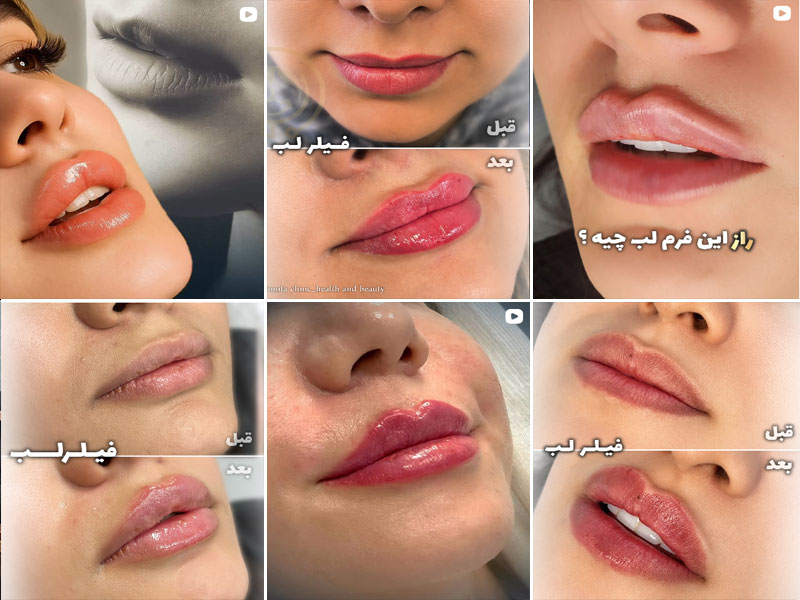 نمونه کار تزریق ژل لب روسی کلینیک بنیتا اصفهان