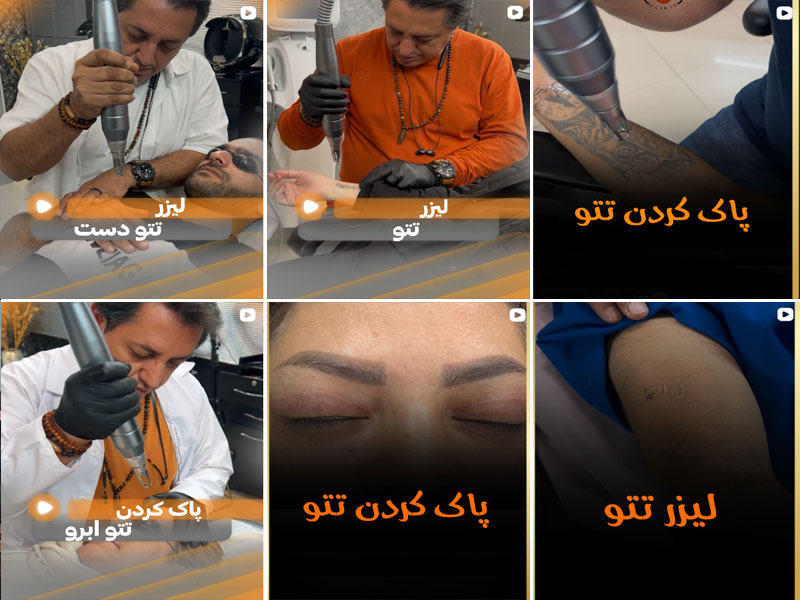 پاک کردن تتو دکتر هومان حسینی اصفهان