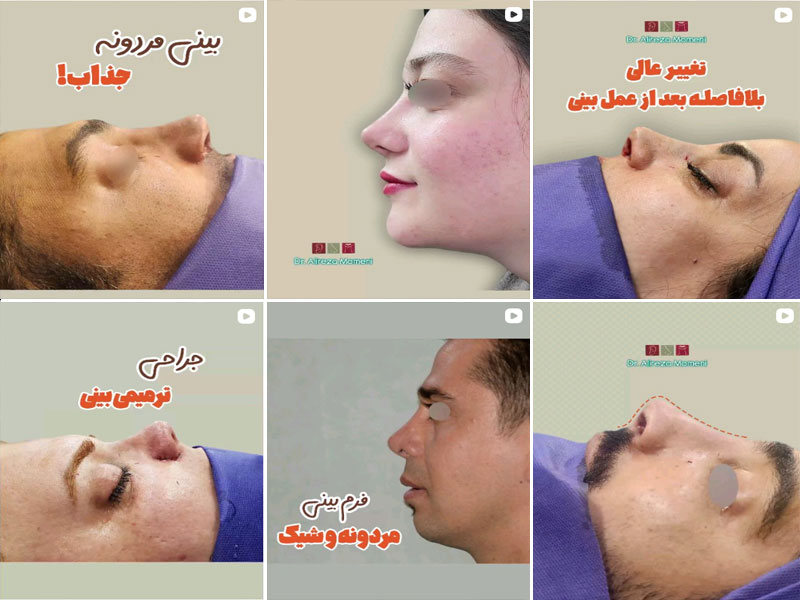 نمونه کار جراحی بینی دکتر علیرضا مومنی اصفهان