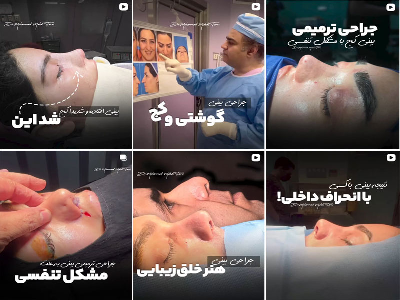 نمونه کارهای جراحی بینی دکتر محمد مهدی طرزی اصفهان