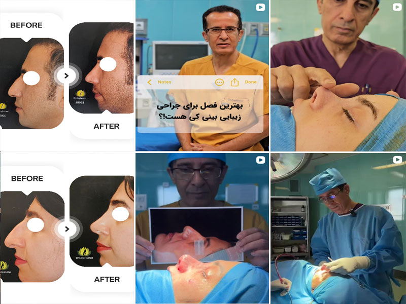 نمونه جراحی بینی دکتر شهریار لقمانی اصفهان