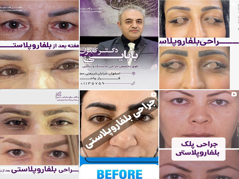 نمونه کار جراحی بلفاروپلاستی دکتر کامران بابایی اصفهان