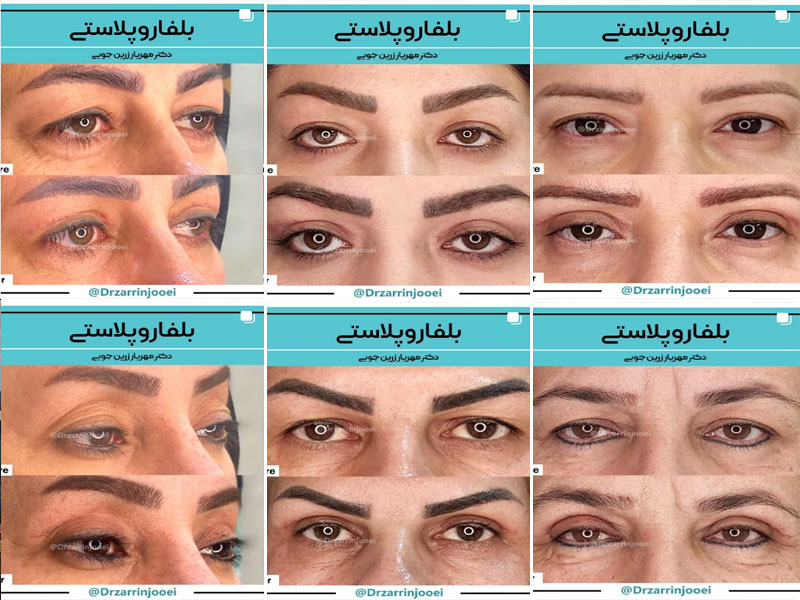 نمونه کارهای بلفاروپلاستی دکتر مهریار زرین جویی اصفهان
