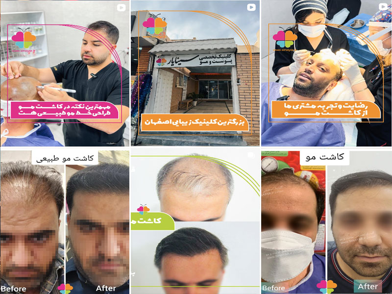 نمونه کار کاشت مو طبیعی در کلینیک سینایار اصفهان