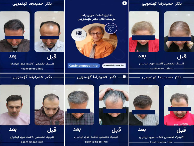 نمونه کارهای کاشت مو کلینیک ایرانیان دکتر کهنمویی اصفهان