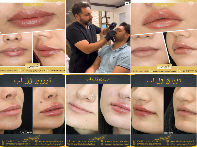 نمونه کار تزریق ژل لب دکتر رامین مدرسی اصفهان