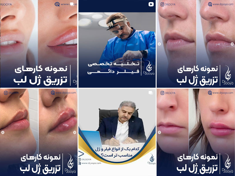 نمونه کار تزریق ژل لب توسط دکتر ابوالفضل جویا اصفهان