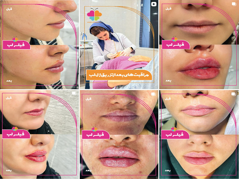 نمونه کارهای تزریق ژل لب کلینیک سینایار اصفهان 