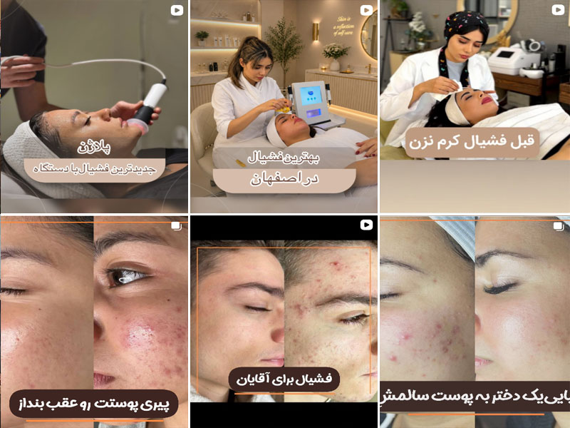 نمونه کار پاکسازی و فشیال صورت در مرکز تخصصی پاکسازی پوست نیلوفر رضایی اصفهان 