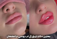 بهترین دکتر تزریق ژل لب روسی در اصفهان