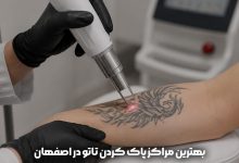 پاک کردن تاتو در اصفهان