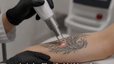 پاک کردن تاتو در اصفهان