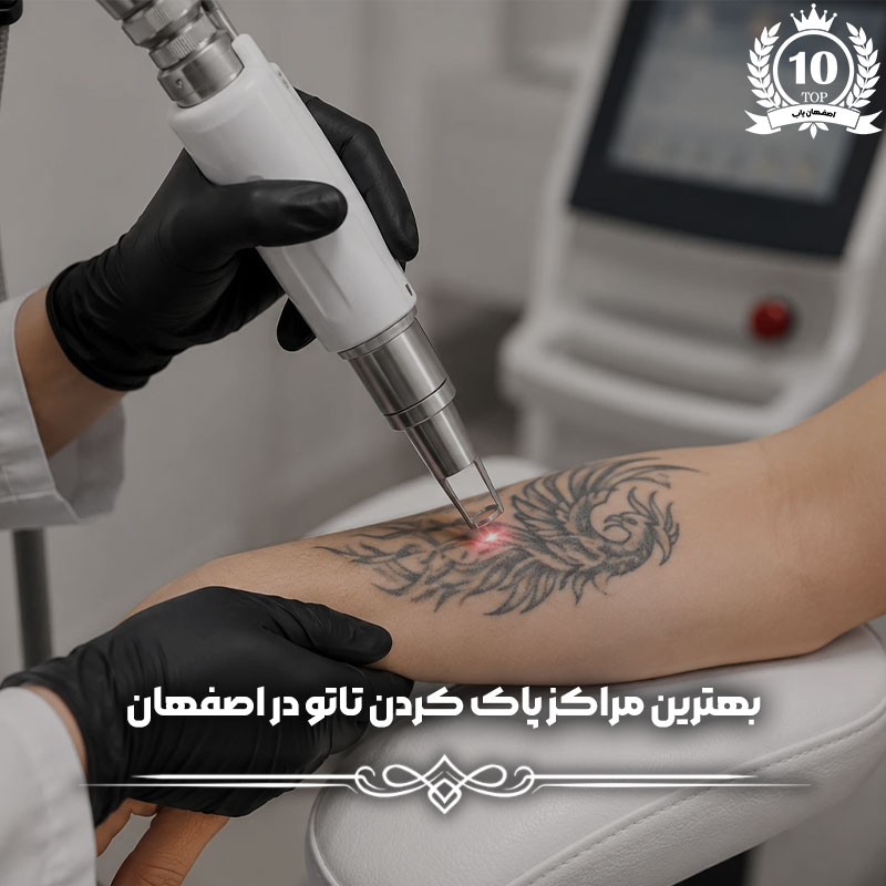 پاک کردن تاتو در اصفهان